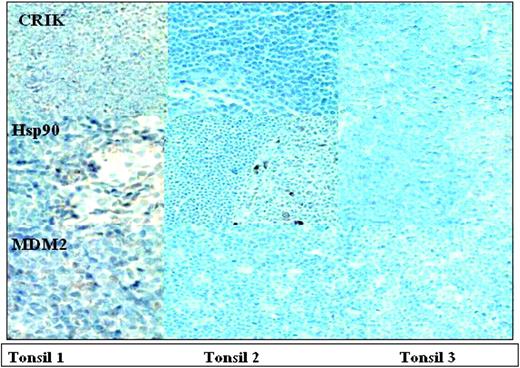 Figure 6. Immunohistochemistry analysis of RCC-1, Hsp90, and MDM2 in several tonsillar tissues. This indicates that the expression of proteins detected in the control sample used in the array analysis is similar to other tonsillar tissues. Image acquisition was performed as in Figure 5.