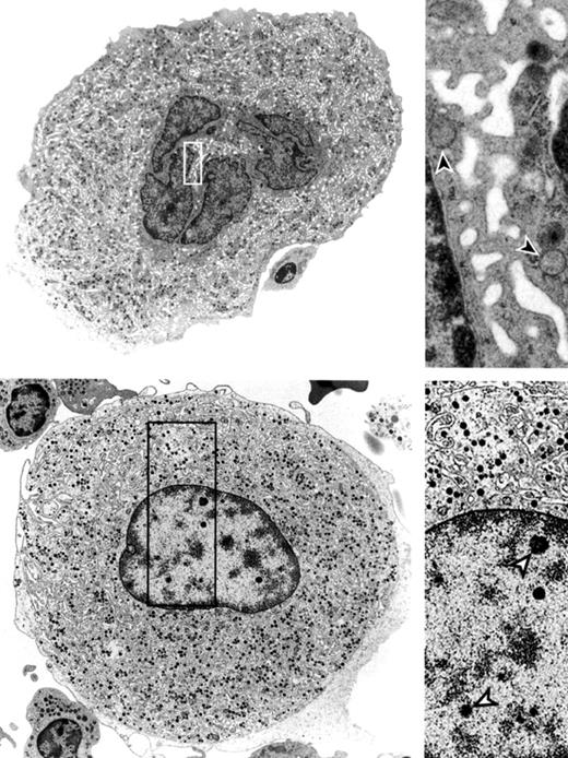 Ultrastructure of megakaryocytes from a healthy bone marrow donor and an MDS patient. See the complete figure in the article beginning on page 3472.