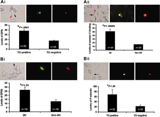 Figure 4. Comparison of young and mature thrombocytes. (A)Measurement of receptor densities of young and mature thrombocytes. (i) From left to right, this panel shows a representative bright field image, TO fluorescence (green), and TRITC fluorescence (corresponding to expression of GPIb) of a young thrombocyte (shown by black arrow). A mature thrombocyte is shown by a red arrow. Bar graph shows the relative levels of GPIb (TRITC fluorescence) on the TO-positive young and TO-negative mature thrombocytes (data collected from 20 different thrombocytes from multiple images shown as n = 20). (ii) From left to right, this panel shows a representative bright field image, DiI fluorescence (red), and FITC fluorescence (corresponding to expression of GPIIb) of a young thrombocyte (shown by arrow). Bar graph shows the relative levels of GPIIb (FITC fluorescence) on the DiI-labeled young thrombocytes and mature (non-DiI) thrombocytes (data collected from 18 different thrombocytes from multiple images shown as n = 18). (B) Measurement of functional activity of young and mature thrombocytes by annexin V binding and P-selectin levels. (i) From left to right, this panel shows a bright field image, green annexin FITC fluorescence (corresponding to expression of phosphatidyl serine), and DiI fluorescence of a young thrombocyte (shown by black arrow). Orange fluorescence in the annexin-FITC image is due to dual labeling of the young thrombocyte by FITC and DiI. Bar graph shows the relative levels of phosphatidyl serine (FITC fluorescence) on the DiI-labeled young thrombocytes and mature (non-DiI) thrombocytes. Mature thrombocytes are shown by red arrows. (ii) From left to right, this panel shows a bright field image, TO fluorescence (green), and TRITC fluorescence (corresponding to expression of P-selectin) of a young thrombocyte (shown by black arrow). Bar graph shows the relative levels of P-selectin (TRITC fluorescence) on the TO-positive young and TO-negative mature thrombocytes. A mature thrombocyte is shown by a red arrow.