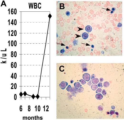 Figure 4. Progression of MDS to acute leukemia. (A) Serial analysis of WBC counts from mouse no. 1018. Note initially normal count, followed by marked leukopenia, terminating with leukocytosis. (B) Peripheral blood showing erythroblasts (arrowheads) and nucleated RBCs (arrows). (C) Bone marrow replaced by erythroblasts, stained with MGG.