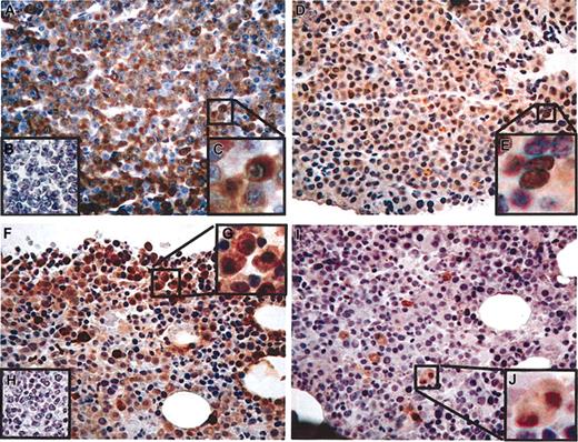 Figure 1. CT antigen immunohistochemistry in stage-III multiple myeloma. (A-E) Patient no. 1. (A) CT7-33 mAb (anti-CT7), greater than 75% of plasma cells positive (graded ++++), × 20 original magnification. (B) Negative control staining without primary antibody. (C) Detail showing predominantly cytoplasmic distribution of staining, × 40 original magnification. (D) M3H67 mAb (anti–MAGE-A3/6), approximately 50% of malignant cells positive (++), × 20 original magnification. (E) Detail showing cytoplasmic and nuclear distribution of staining, × 40 original magnification. (F-J) Patient no. 2. (F) CT7-33 mAb, approximately 20% of plasma cells positive (+), × 20 original magnification. (G) Negative control staining without primary antibody. (H) Detail showing predominantly cytoplasmic distribution of staining, × 40 original magnification. (I) M3H67 mAb, less than 5% of malignant cells positive (focal), × 20 original magnification. (J) Detail showing cytoplasmic and nuclear distribution of staining, × 40 original magnification.