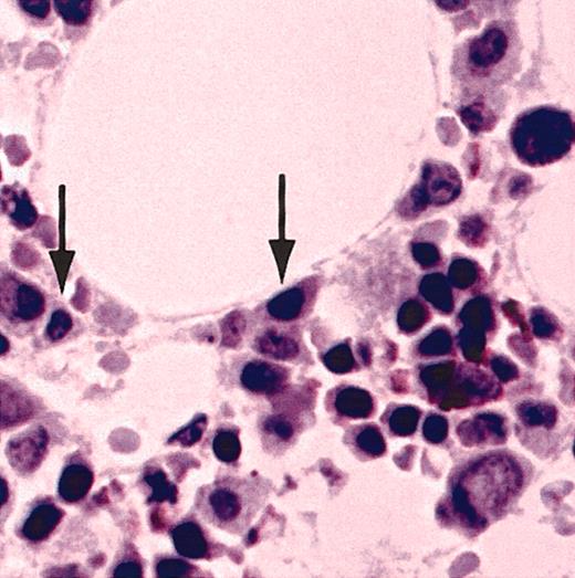 Figure 2. Normal bone marrow plasma cells do not express CT7. A bone marrow biopsy specimen from a healthy donor was stained with CT7-33 mAb. Arrows indicate normal bone marrow plasma cells, which do not stain for CT7. Original magnification, × 20.