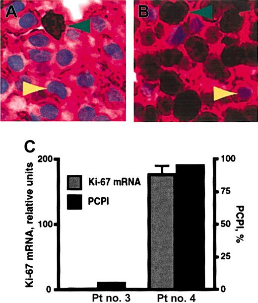 Figure 3. The plasma-cell proliferation index (PCPI). (A, patient no. 3; B, patient no. 4) Representative multiple myeloma bone marrow biopsy specimens double-stained with anti-CD138 and anti–Ki-67 antibodies. The majority of cells in these sections are plasma cells, which exhibit crimson membrane staining with anti-CD138 mAb. Green arrowheads indicate positive nuclear staining (dark brown pigment) for Ki-67. Yellow arrowheads denote light blue nuclei that do not stain for Ki-67. Original magnification × 50. (C) PCPI and real-time RT-PCR for Ki-67 mRNA were compared for patient (Pt) no. 3 and no. 4 from panels A and B, respectively. PCPI is expressed as percentage of Ki-67–positive plasma cells within the CD138+ population. Error bars show the standard error of the mean.