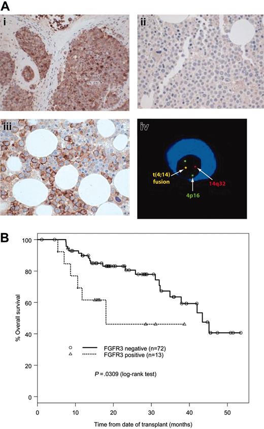 Figure 1. FGFR3 immunoreactivity and OS. (A) Detection of FGFR3 and t(4;14) in MM. Immunohistochemistry study with anti-FGFR3 antibody showed a positive reaction with the tumor tissue from the t(4;14) KMS11 cell line–injected mouse (i), a negative reaction with a bone marrow biopsy from a t(4;14)-negative myeloma patient (ii), and a positive reaction with a bone marrow biopsy from a t(4;14)-positive myeloma patient (iii). cIg-FISH showed a fusion signal indicating a t(4;14) translocation in a myeloma cell (iv). (B) OS of MM patients according to FGFR3 expression by IHC. The image in panel iv was obtained with an Axioscop microscope equipped with UPlanFl 20 ×/0.40 and 40 ×/0.75 objective lenses (Zeiss, Jena, Germany).