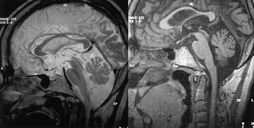 Figure 1. MRI results. MRI of CNS from patients 1 (left) and 3 (right), in sagittal view, showing cerebellar volume loss in both cases but normal brainstem size.