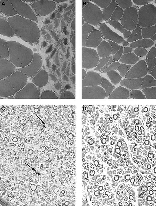 Figure 2. Histologic results. Muscle and nerve histology in CHS patients 26 (patient 1) and 21 years (patient 3) after transplantation. (A-B) Muscle samples of patient 3 (A) and 1 (B) demonstrate areas of neurogenic atrophy of muscular fibers, which were more prominent in patient 3 (hematoxylin-eosin stain). (C-D) Semithin sections of samples from patient 3 demonstrate moderate rarefaction of large myelinated fibers, few remyelinated fibers, and endoneural macrophages containing dense osmiophilic inclusions (arrows in panel C; Toluidine blue stain). Images were visualized under a Laborlux 5 type 020505030 inverted microscope equipped with a dry periplan 10×/0.25 objective lens (Leitz, Portugal) and an Olympus OM-4T camera (Olympus, Melville, NY). Adobe Photoshop CS.8 software (Adobe, San Jose, CA) was used for image processing.