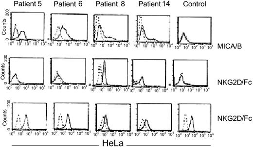 Figure 4. Expression of NKG2D ligands MICA/B on CD34 CML cells. From left to right: patients 5, 6, 8, and 14. Top panel: CD34+ CML cells and normal CD34+ cells were stained with polyclonal anti-MICA/B (solid line) or isotype antibodies (dashed line). Middle panel: direct binding of an NKG2D/Fc chimeric molecule to the CD34 CML cells from the indicated patients (solid lines). The bound NKG2D/Fc was detected by a PE-conjugated anti-NKG2D that was also used as a negative control (dashed lines). Lower panel: direct binding of NKG2D/Fc (solid line) to MICA+ HeLa cells or PE-conjugated anti-NKG2D used as negative control (dashed lines). HeLa cells were used as an internal positive control for each patient indicated in the middle panel (variability of HeLa staining may reflect batch or dose variation in NKG2D/Fc antibody).