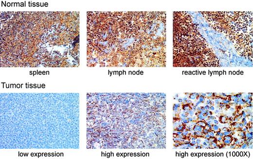 Figure 3. Immunohistochemical staining of MnSOD protein in normal human lymphoid tissues and DLBCL patient samples. The top row of photomicrographs shows immunohistochemical staining for MnSOD protein (brown) in normal spleen, lymph node, and a reactive lymph node (antigen stimulated). The bottom row shows staining in 2 different patient samples selected to represent, from left to right, low and high MnSOD staining. These images are from different tissue samples on the same tissue array slide (original magnification, × 400). The third panel (far right) in the bottom row is a higher magnification (original magnification, × 1000) view of the high MnSOD-staining tumor sample shown in the middle panel of the bottom row. The large atypical cells clearly show a cytoplasmic staining pattern. Images were viewed on a Nikon Labphot 2 microscope using 40×/0.65 and 100×/1.25 oil-immersion objective lenses (Nikon, Melville, NY). Images were acquired with a SPOT RT Color 2.2.0 camera (Diagnostic Instruments, Sterling Heights, MI) and Spot Advanced 4.0.9 software for Windows. Cover slips were mounted on the slides using Pro-Texx Mounting Medium (VWR International, West Chester, PA).