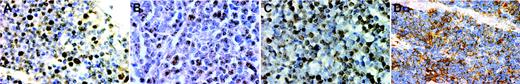 Figure 2. Immunohistochemistry for E2A and ID2 from LBLs and thymus of premature infants. Note the nuclear E2A stain in both the thymus (A) and a T-LBL (B). For ID2, the staining is nuclear in the normal thymus (C) but cytoplasmic in a case of T-LBL (D). (A-D, × 400, immunohistochemistry using formalin-fixed, paraffin-embedded tissue sections and hematoxylin counterstain). Images were visualized under an Olympus BX60 microscope equipped with a Plan-Apo 40×/0.95 objective lens, and were captured with a DP70 digital camera (Olympus, Tokyo, Japan).