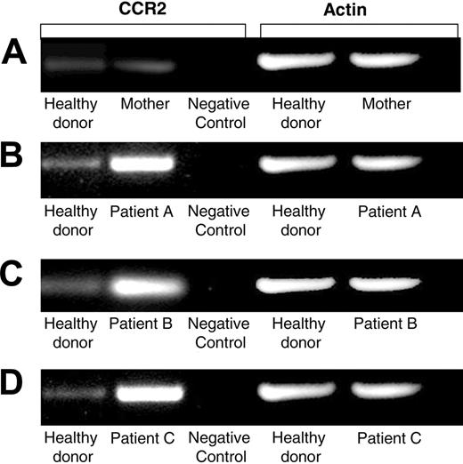 Figure 5. Increased mRNA levels of CCR2 receptor in TAP-2–deficient CANK cells. Semiquantative RT-PCR analysis for CCR2 mRNA levels was performed on various cDNA libraries obtained. Healthy donor–derived cDNA was prepared from an mRNA pool purified from equal numbers of CANK cells from 7 healthy persons. cDNA obtained from 1106 melanoma cell line was used as a negative control for CCR2 receptor. RT-PCR analysis was performed to compare intensities of CCR2 levels on CANK cell lines between healthy donors and (A) the mother of patients A, B, and C with TAP-2 deficiency, (B) patient A, (C) patient B, and (D) patient C. Results are from 1 independent experiment of 4 experiments performed.