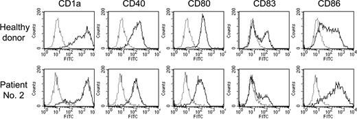 Figure 2. Surface phenotype of DCs derived from PBMCs from healthy donors and PBSC harvests from patients with MM. Monocyte fractions were obtained from PBMCs from healthy donors or PBSC harvests from MM patients using a plastic adherence method. These cells were cultured in the presence of IL-4 and GM-CSF for 6 days, followed by stimulation with TNF-α for 24 hours. Cells were stained with either FITC-labeled control mouse IgG (dotted line) or FITC-labeled anti-CD1a, anti-CD40, anti-CD80, anti-CD83, or anti-CD86 MoAbs (solid line) and were analyzed by flow cytometry. The data were representative of DCs from 3 healthy donors and 3 MM patients.