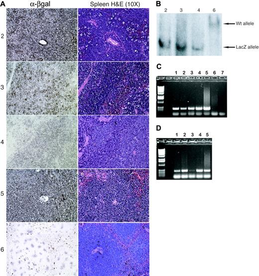Figure 2. T-lymphoblastic lymphoma is of ES-cell origin in Runx1lacZ/lacZ chimeras. (A) Immunohistochemistry using an anti–β-galactosidase antibody demonstrates that the malignant cells in the spleens of LZD nos. 2 through 5 express β-galactosidase and are therefore derived from Runx1lacZ/lacZ ES cells. The normal splenocytes from LZD no. 6 (which did not develop lymphoma) serve as negative controls. (B) Southern blot analysis detects presence of only the Runx1-LacZ knock-in allele in lymphoma-effaced bone marrow from LZD nos. 2 through 4 but only wild-type Runx1 allele from normal bone marrow of LZD no. 6. (C) Genomic PCR using LacZ gene primers and DNA from sorted thymic cells of a Runx1lacZ/lacZ chimera. Lane 1, CD8+; lane 2, CD8+/CD4+; lane 3, CD4-/CD8-; lane 4, CD4+; lane 5, total thymus; lane 6, total thymus from a wild-type mouse; lane 7, no DNA. (D) Genomic PCR using LacZ gene primers and DNA from sorted bone marrow cells of a Runx1lacZ/lacZ chimera. Lane 1, c-kit+/lin-; lane 2, c-kit+/lin+; lane 3, c-kit-/lin+; lane 4, c-kit-/lin-; lane 5, total bone marrow.