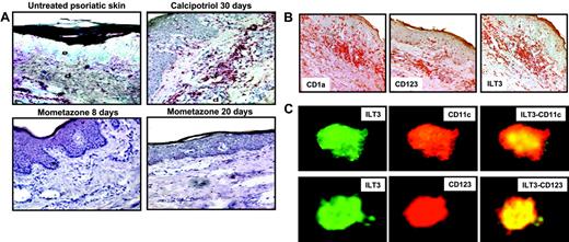 Figure 3. VDR agonists induce in vivo up-regulation of ILT3 on M-DCs and P-DCs in psoriatic lesions. (A) Skin biopsies from untreated psoriatic lesions, psoriatic plaques treated for 30 days with calcipotriol, and psoriatic plaques treated for 8 or 20 days with mometazone furoate were stained with anti-ILT3 mAb and counterstained with hematoxylin, as described in “Materials and methods.” Original magnification × 200, except top left panel (× 50); e indicates epidermis; d, dermis. (B) Noncounterstained serial sections from calcipotriol-treated psoriatic lesions shown in panel A stained with anti-CD1a, anti-CD123, and anti-ILT3. Original magnification × 100. (C) Expression of ILT3 in M-DCs and P-DCs from the calcipotriol-treated psoriatic lesions shown in panel A. Sections were stained with anti-ILT3 and anti-CD11c or anti-CD123, respectively, and analyzed by confocal microscopy. Merged stainings are shown in the right panels. The results refer to analysis of 1 representative patient out of 5 examined.