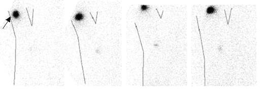 Figure 1. Sequential planar gamma images (left to right, 2 hrs, 18 hrs, 51.5 hrs and 75 hrs after injection) in one pt after ID injection of mDC. The arrow indicates injection site over the right deltoid in the raised arm (shown as outline) with subsequent progressive accumulation of cells into afferent axillary LN. Conclusion ID and SC images suggest mDC track more consistently to LN, whilst IV mDC cleared more slowly from lungs at 24h compared to imDC.