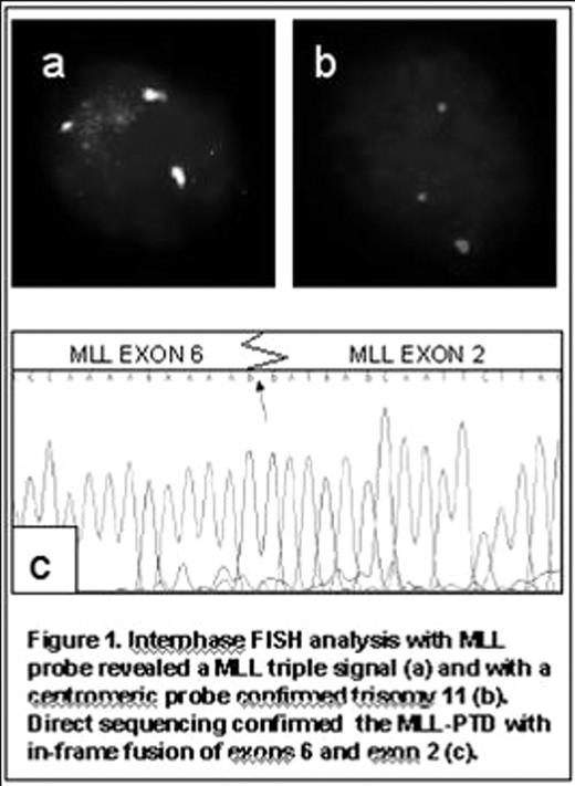 Figure 1. Interphase FISH analysis with MLL probe revealed a MLL triple signal (a) and with a centromeric probe confirmed trisomy 11 (b). Direct sequencing confirmed the MLL PTD with in-frame fusion of exons 6 and exon 2(c).