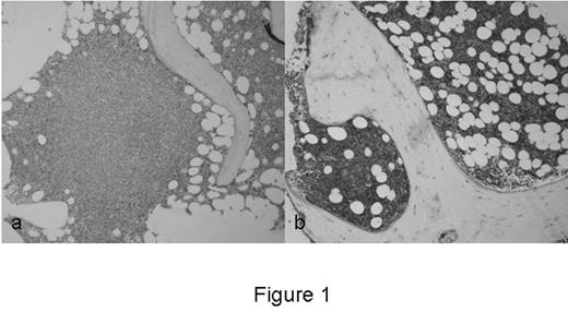 Figure 1:. low power view of activin staining in the vicinity of the involved BM (a) and uninvolved BM (b).