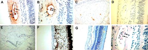 Figure 6. α-Defensins in human diabetic retinas. Ocular tissue from 5 patients with diabetes mellitus and 5 cases of traumatic injury in persons without diabetes mellitus were stained for α-defensins. Sections were stained with a rabbit antiserum that recognizes HNP1-3 or serum from unimmunized rabbits at the same dilution as a control. Normal-appearing regions of the retina in samples from patients with diabetes mellitus stained for α-defensin (A-C). In contrast, α-defensins were not detected in diabetic retinas when the normal rabbit serum control was used as first antibody (D). Little or no expression of α-defensins was noted in proliferative retinal vessels (E) or in proliferative vessels at the rubeotic membrane (F). α-Defensins were not detected in retinal vessels from eyes removed because of trauma (G). Hematoxylin and eosin staining identified neutrophils (H).