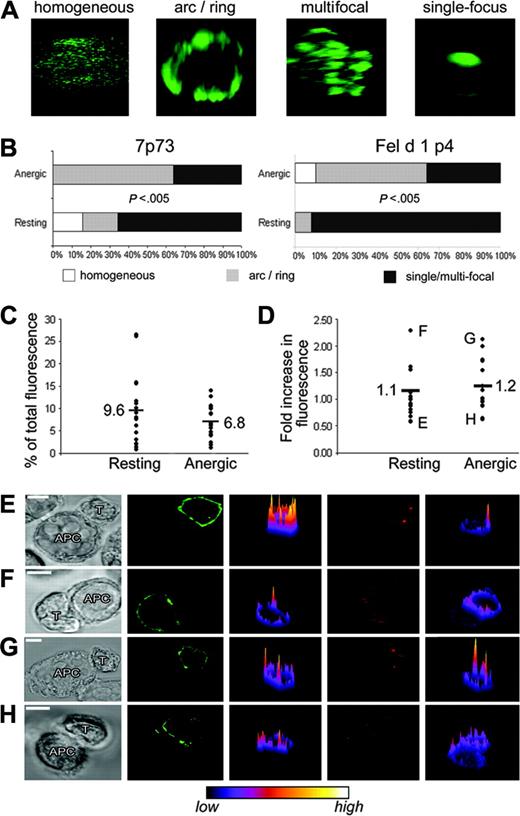 Figure 2. CD3 organization at the resting and anergic human T-cell IS. (A) Organization of CD3ϵ at the T-cell-APC contact was categorized as follows: homogeneous indicates no clear polarization; arc/ring, ring- or arc-shaped CD3 accumulation; and single/multifocal, multiple foci or a single focus of CD3 accumulation. Examples of these categories, which are representative for both resting and anergic T cells, are given. (B) Charts show the percentage of each type of CD3 organization at synapses between APCs and resting or anergic 7P.73 T cells or Fel d 1 p4 T cells. P value is less than .005 for both 7P.73 and Fel d 1 p4, comparing the CD3 organization in resting versus anergic T cells. The amount of CD3 at the T-cell-APC contact was calculated as a percentage of total CD3 on the T cell (C), or as a fold increase in comparison with an area away from the intercellular contact (D). Plots show measurements for individual conjugates as dots and the mean for resting and anergic 7P.73 T-cell synapses. (E-H) Representative conjugates are shown that depict high or low levels of CD3 accumulation at the IS. The corresponding data points are marked on panel D. (E) Fel d 1 p4 resting T cell, (F) 7P.73 resting T cell, (G) Fel d 1 p4 anergic T cell, and (H) 7P.73 anergic T-cell-APC conjugates were stained with a pan class I MHC mAb to control for nonspecific membrane accumulation at the IS. The images from left to right are transmitted light; CD3ϵ; CD3ϵ intensity profile; class I MHC; class I MHC intensity profile. The intensity profiles have been color coded (confocal software; Leica) according to the scale given below the images. Scale bars represent 5 μm.