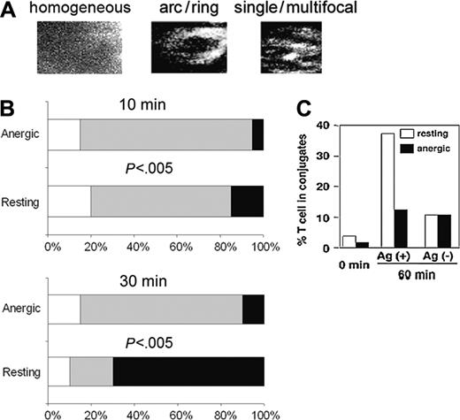 Figure 3. Assembly of the resting and anergic T-cell IS after 10 and 30 minutes. (A) Organization of CD3ζ at the HA308 T-cell-APC contact was categorized as follows: homogeneous indicates no clear polarization; ring/arc, ring- or arc-shaped CD3 accumulation; and single/multifocal, multiple foci or single focus of CD3 accumulation. (B) Charts show the percentage of resting T-cell-APC or anergic T-cell-APC conjugates exhibiting each type of CD3ζ organization at the IS. Cells were fixed and stained 10 or 30 minutes after coincubation. Comparing CD3ζ organization at the IS formed by anergic or resting T cells, P was less than .005 for both 10 minutes and 30 minutes, even though at 30 minutes the difference in distribution of patterns is more striking. □ indicates homogeneous; ▦, arc/ring; ▪, single/multifocal. (C) The percentage of resting and anergic HA308 T cells conjugated to APCs was assessed by flow cytometry at 0 and 60 minutes after coincubation with APCs in the presence or absence of agonist peptide.