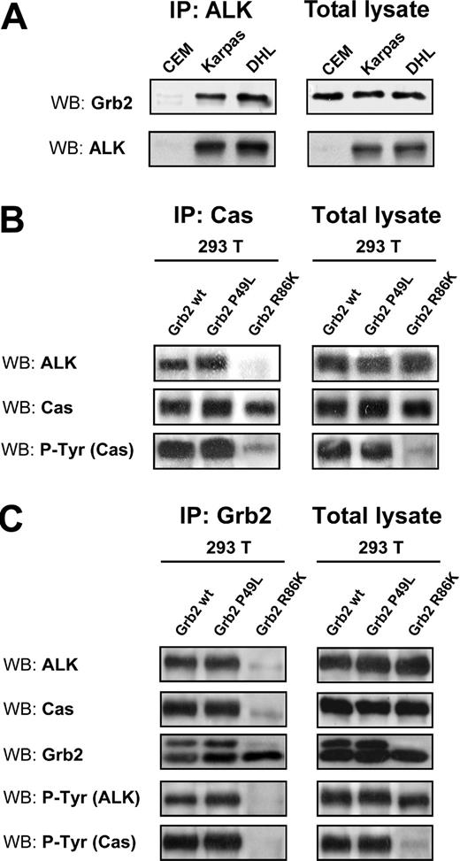 Figure 5. NPM-ALK binds p130Cas through the SH2 domain of Grb2. (A) NPM-ALK binds Grb2 in lymphoid cell lines. Total lysates were immunoprecipitated with anti-ALK monoclonal antibody and blotted with the indicated antibodies. (B-C) The 293 T cells were transfected with Pallino NPM-ALK, Pallino p130Cas, pRK5 Grb2, and the dominant-negative Grb2 constructs pRK5 P49L (mutated in the SH3 domain) or pRK5 R86K (mutated in the SH2 domain) as indicated. Samples were collected 48 hours after transfection and total lysates were immunoprecipitated with anti-Grb2 polyclonal antibody and blotted with the indicated antibodies. Grb2 R86K was able to disrupt the binding of p130Cas to NPM-ALK (B) as well as p130Cas phosphorylation (C).