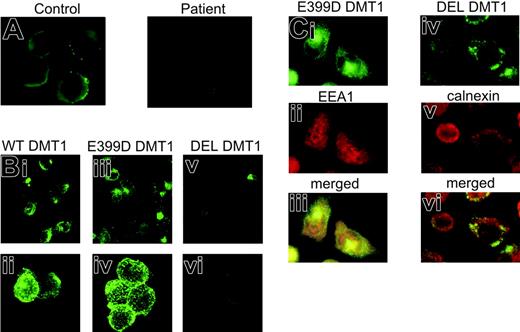 Figure 2. Immunofluorescence analysis of DMT1 in BFU-E-derived erythroblasts and transfected CHO cells. (A) Day 14 healthy control and the patient's BFU-Es were harvested, cytospun, and stained using goat anti-Nramp2 antibody (1/50, 3 hours, room temperature) and fluorescein isothiocyanate (FITC)-conjugated secondary antibody (Molecular Probes, Eugene, OR; 1/1000, 90 minutes, room temperature). (B) Immunostaining of WT (i-ii), E399D (iii-iv) and DEL (v-vi) DMT1 in transiently transfected CHO cells with mouse anti-HA antibody (1/200, 1 hour, room temperature) and FITC-conjugated secondary antibody (1/1000, 1 hour, room temperature). (C) Subcellular localization of E399D DMT1 in early endosomes (i-iii) and DEL DMT1 in the endoplasmic reticulum (iv-vi) in stably transfected CHO cells. Cells immunostained with mouse anti-HA antibody and with FITC-conjugated secondary antibody were subsequently stained either with anti-EEA1 antibody (1/200, 1.5 hours, room temperature) or anti-calnexin antibody (1/200, 1.5 hours, room temperature) followed by incubation with red-fluorescent-conjugated secondary antibody (Alexa Fluor 594, Molecular Probes; 1/1000, 1.5 hours, room temperature). In panels A and C the cells were visualized on an Olympus BX 50 fluorescence microscope (Olympus, Hamburg, Germany) using a 100 ×/1.3 numeric aperture (NA) oil immersion objective. Digital images were acquired with an Olympus DP 50 camera driven by the software Viewfinder Lite version 1.0.135 (Pixera, Los Gatos, CA). Original magnifications, × 1000. In panel B the cells were examined on a Zeiss Pascal 5 confocal microscope (Carl Zeiss, Jena, Germany) using a 40 ×/0.75 NA objective (i, iii, v) and a 63 ×/1.4 NA oil immersion objective (ii, iv, vi). The Zeiss LSM Browser version 3.2.0 115 was used for handling pictures. Images were cropped, assembled, and labeled using Adobe Photoshop software (Adobe Systems, San Jose, CA).