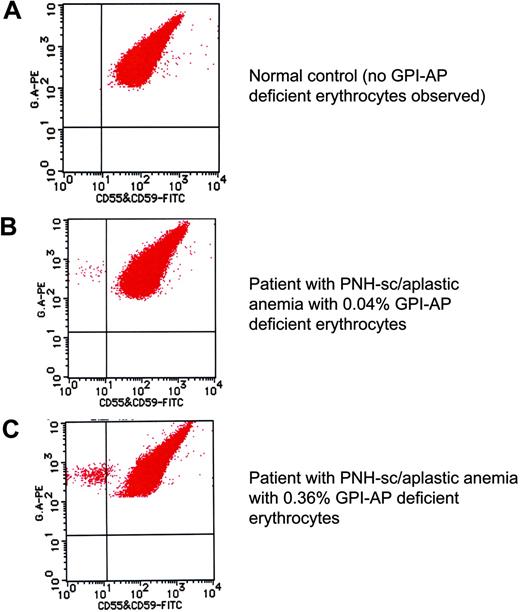 Figure 3. High-sensitivity flow cytometric analysis of erythrocytes. By careful gating and by using dual-color flow cytometry, GPI-deficient cells that comprise less than 1% of the total erythrocyte population can be reliably and reproducibly demonstrated (B-C).2 Using this technique, GPI-AP–deficient cells are not identified in the peripheral blood of the controls (volunteer donors; A). A combination of FITC-labeled anti-CD55 and anti-CD59 was used along with phycoerythrin (PE)–labeled anti–glycophorin A for the dual staining. These data were kindly provided by Dr Shinji Nakao and Dr Chiharu Sugimori, Kanazawa University, Japan, and are used with their permission. Illustration enhanced by A. Y. Chen.