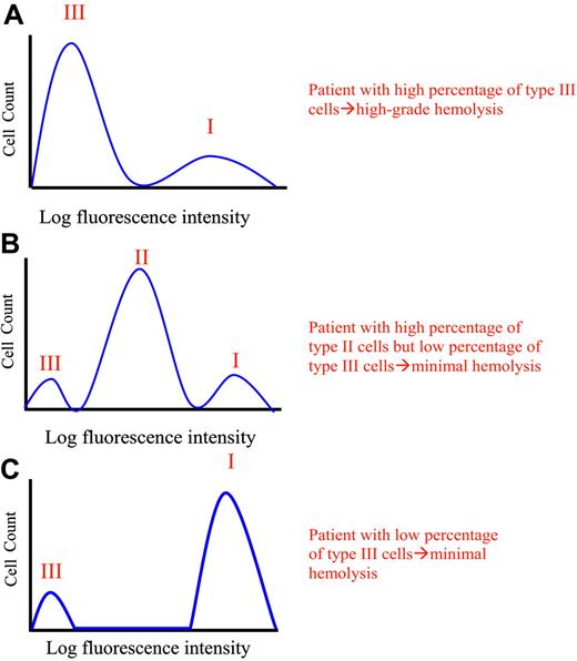 Figure 4. Phenotypic mosaicism in PNH. Hypothetical histograms of erythrocytes from patients with PNH stained with anti-CD59 are illustrated. The proportion and type of abnormal erythrocytes varies greatly among patients with PNH and these characteristics are important determinants of clinical manifestations. In general, patients with a high percentage of type III erythrocytes have clinically apparent hemolysis (A). If the erythrocytes are partially deficient in GPI-AP, hemolysis may be modest even if the percentage of the affected cells is high (B). A patient may have a diagnosis of PNH, but if the proportion of type III cells is low, only biochemical evidence of hemolysis may be observed (C). Illustration enhanced by A. Y. Chen.