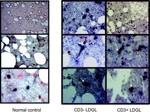 Figure 4. Immunohistologic analysis of DCs and GLs in patients with CD3+ and CD3- LDGL. Immunoperoxidase staining for CD56 and CD57 (red) and CD1a and CD83 (black) in bone marrow biopsies from control and representative patients with CD3- and CD3+ with LDGL. An evident contact between the 2 cell types can be seen in patients with LDGL indicated by arrows. However, GLs and DCs were clearly separated in healthy control subjects (left).