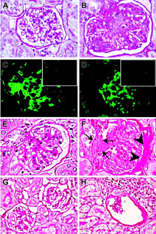 Figure 1. Mesangioproliferative glomerulonephritis in Il12rb2 KO mice. A glomerulus from an 8-month-old WT mouse displays the tuft of capillaries with an open lumen filled by erythrocytes and supported by a delicate branching framework of mesangium (A, PAS staining). In contrast, a glomerulus from an age-matched Il12rb2 KO mouse shows mesangial enlargement caused by mesangial hypercellularity (blue-stained nucleus) and matrix increase (fuchsia-stained material) resulting in capillary compression and occlusion (B, PAS staining). Immunofluorescent staining shows diffuse mesangial immunoreactivity for IgG (C) and for C3 (D) along the glomerular capillary loops in an Il12rb2 KO mouse, as opposed to the negative staining of glomeruli from an age-matched WT mouse (insets in C and D, respectively). H&E staining of kidney sections from a 21-month-old Il12rb2 KO mouse revealed, in contrast with the normal glomerulus from an aged-matched WT mouse (E), an advanced sclerosing glomerulonephritis with crescent formation (arrows) and adhesion to Bowman capsule, associated with thickening of its parietal layer (F). Altered glomeruli compressed by lympho-plasmacytoid infiltrates are observed in a 26-month-old Il12rb2 KO mouse (H), but not in an age-matched WT mouse (G). Magnification: (A-F) × 1000; (G-H) × 630.