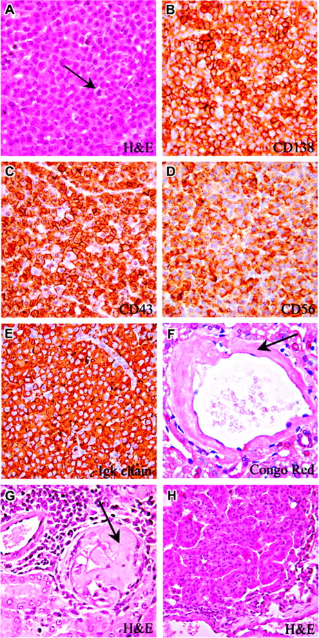 Figure 5. Plasmacytoma and bronchoalveolar carcinoma in Il12rb2 KO mice. A 21-month-old mouse showing a mature lymph node plasmacytoma with cells characterized by low nuclear-cytoplasmic ratio and abundant cytoplasm (A). Some mitoses are observed (A, arrow). Plasmacytoid cells express CD138 (B), CD43 (C), and CD56 (D). Panels E and F show amyloidosis detected in the liver (F, Congo red staining) and kidney (G, Giemsa staining) from 2 plasmacytoma-bearing mice. A 22-month-old mouse has developed bronchoalveolar carcinoma of the lung. This epithelial tumor is formed of well-differentiated mucin-containing columnar cells lining the respiratory spaces (G). Magnification: (A-G) × 630; (H) × 400.