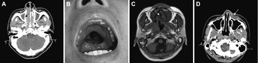 Figure 1. Local tumor invasiveness. (A) Thinning of right medial wall of maxillary bone (arrow) in CT of paranasal sinuses. (B) Palatal perforation on physical examination. (C) High signal intensity of hard palate is not delineated in T1-weighted MRI (arrow). (D) Skin infiltration by tumor (arrow) in CT of paranasal sinuses. Picture was taken with an Olympus Camedia C4000Z camera (Olympus, Tokyo, Japan). Adobe Photoshop 6.0 was used to process images (Adobe, San Jose, CA).