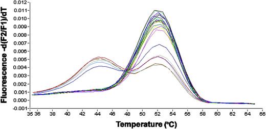 Figure 1. LightCycler-based melting curve analysis. Depicted is the first derivation of the melting curve. The y-axis represents fluorescence intensity and the x-axis represents the temperature. Due to mismatches, mutations led to decreased melting temperatures of the hybridization probes from the amplification product. The peak at 52°C represents the wild-type allele, the peaks at 44°C represent mutated alleles. All mutated cases are heterozygous for the mutation and retain a wild-type allele, leading to double peaks in these cases.