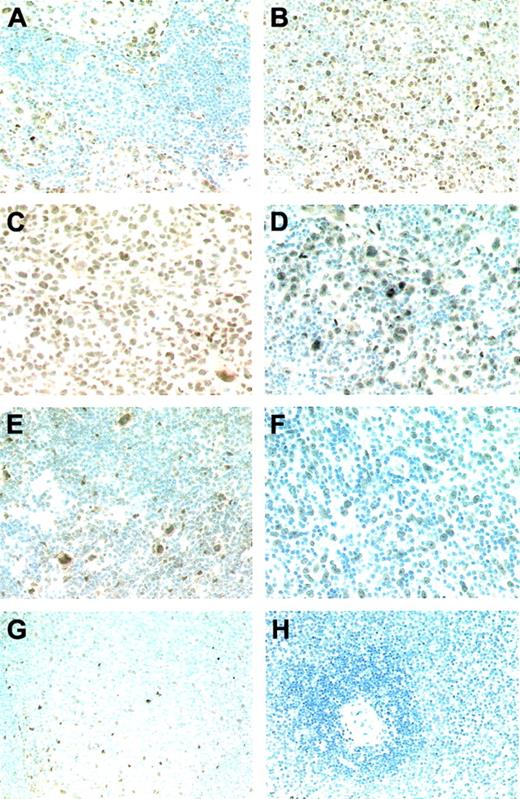 Figure 5. Bcl-3 staining of primary lymphomas (all immunoperoxidase with hematoxylin counterstain). (A) Strong nuclear expression of Bcl-3 in all neoplastic cells of an ALK-positive ALCL case with an intrasinusoidal growth pattern. (B) Variable expression intensity of Bcl-3 ranging from strong to intermediate in sheets of neoplastic cells of a further ALK-positive ALCL case. (C) The expression pattern of ALK-negative ALCL is similar to that of the ALK-positive cases. (D) The Hodgkin and Reed-Sternberg cells of a cHL case show a predominantly strong nuclear Bcl-3 expression. Also, cells of the surrounding inflammatory background infiltrate display a weak Bcl-3 expression. (E) Detection of a strong nuclear Bcl-3 expression in the L&H cells of an LPHL case accompanied by faintly labeled bystander cells. (F) Bcl-3 expression in the neoplastic cells of a DLBCL, whereas the numerous non-neoplastic smaller lymphocytes of the background infiltrate are completely Bcl-3 negative. (G) Within normal lymphoid tissue, a weak nuclear Bcl-3 expression is solely observed in follicular dendritic cells of germinal centers. (H) No Bcl-3–expressing cells are detectable in the white and red pulp of the spleen.