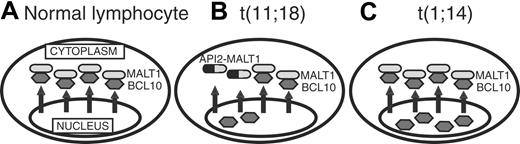 Figure 7. A model for subcellular localization of BCL10 under various conditions. (A) Normal lymphocyte: BCL10 is localized in cytoplasm because nuclear BCL10 is exported by MALT1. (B) t(11;18) MALT lymphoma: Normal MALT1 products are reduced by half because the translocated allele generates API2-MALT1. Since the API2-MALT1 cannot export nuclear BCL10, the reduction of normal MALT1 proteins will be less efficient in BCL10 exportation, resulting in nuclear retention of BCL10. (C) t(1;14) MALT lymphoma: Overexpressed BCL10 results in nuclear retention because of a relative shortage of MALT1.