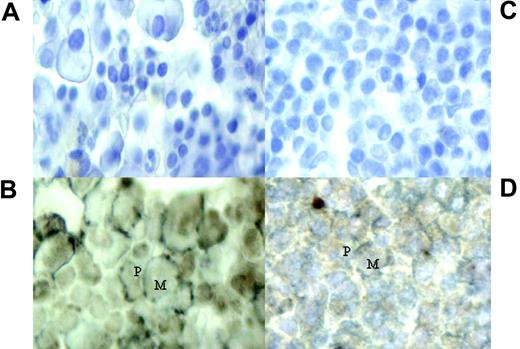 Figure 5. Dual immunohistochemistry staining of bone marrow trephines with primary antibodies to CD138 and MAGE/NY-ESO. (A,C) Negative stains of bone marrow from patients 4 and 22, respectively. (B,D) Cytoplasmic and nuclear expression of MAGE and NY-ESO/LAGE-1 within the CD138+ cells of patients 4 and 22, respectively. Expression of CGAgs shown as brown stain (M) and CD138 plasma cells are stained with a silver/gray surface stain (P). Images were captured with a Nikon Eclipse E400 microscope with a 40×/0.65 NA objective (Tokyo, Japan) and a Nikon E995 camera.