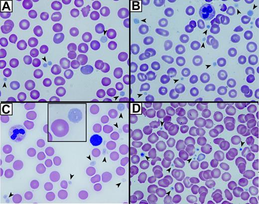 Figure 1. Abnormal platelets observed in blood films from patients with ARC syndrome. Romanowsky (Wright-Giemsa)–stained blood films from 3 patients with ARC syndrome (A-C) and a neonatal control (D) visualized using oil-immersion 63×/1.32-0.6 objective lenses). Large homogeneous, nongranular gray-appearing platelets (arrows) are observed in the fetal (A), the related neonatal (B), and unrelated neonatal (C) patients with ARC syndrome (A). Inset (C) shows magnified view of a typical large platelet compared with an erythrocyte taken from the top right corner of the underlying image. Normal neonatal control platelets (D) are typically smaller, granular, and stained dark blue (arrows).