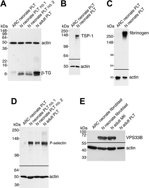 Figure 4. Soluble and membrane-bound α-granule protein deficiencies in ARC platelets and the presence of VPS33B in normal fibroblasts and megakaryocytes. Immunoblots comparing megakaryocyte (MK) and platelet (PLT) or fibroblast whole-cell lysates from ARC and normal (N) neonatal and adult sources as indicated for each lane. Actin was visualized as a protein concentration loading control. (A) Significantly decreased β-TG was observed in ARC neonatal platelets (lane 1) compared with normal neonatal (lanes 2, 3) and adult (lane 4) platelets (reduced 15% SDS-PAGE; β-TG and actin were probed and developed simultaneously). (B) ARC platelets contained undetectable amounts of TSP-1 (lane 1) compared with normal neonatal platelets (lane 2, reduced 10% SDS-PAGE). (C) Fibrinogen was undetectable in ARC platelets (lane 1) despite its normal presence in neonatal control platelets (lane 2, nonreduced 9% SDS-PAGE) and ARC plasma (not shown). (D) The α-granule membrane-containing protein P-selectin was virtually undetectable in ARC platelets (lane 1) when compared with normal neonatal (lanes 2, 3) and adult (lane 4) platelets (reduced 8% SDS-PAGE, stripped VWF blot from Figure 3C). (E) Affinity-purified polyclonal anti–human VPS33B detected VPS33B in normal neonatal fibroblasts (lane 2) and normal adult megakaryocytes (lane 3), but not in ARC neonatal fibroblasts (lane 1) or normal adult control platelets (lane 4). Actin immunostaining is shown on the same blot.