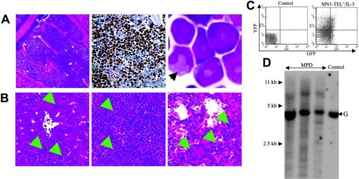 Figure 4. Characteristics of the myeloproliferative disease induced by coexpression of MN1-TEL and IL-3. (A) Myeloproliferation in mice that received transplants of MN1-TEL+/IL-3 cells. (Left) Hematoxylin-Eosin (H-E) staining of BM; (middle) myeloperoxidase staining of BM; (right) M-G staining of BM cells. An arrow indicates a cell with differentiated morphology. (B) Aggressive organ infiltration by myeloid cells in mice that received transplants of MN1-TEL+/IL-3 bone marrow. H-E staining of liver (left), spleen (middle), and lung (right). Arrows indicate infiltrations of the myeloid cells. Images were obtained as previously described.12 (C) GFP and YFP expression in BM cells from mice that received transplants of MN1-TEL+/IL-3 cells. FCM analysis was performed as described in Figure 3A. (D) Clonality of MN1-TEL+/IL-3+ myeloproliferative disease (MPD). Genomic DNA of MPD BM cells was digested with BglII and hybridized with an Il3 probe. Control indicates untransduced BM; and G, germ line band.