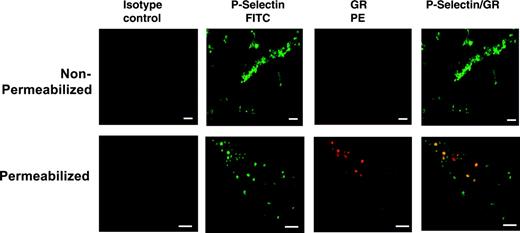 Figure 2. Detection of GR in human platelets by confocal analysis. Washed platelets were permeabilized with saponin or left intact (“Materials and methods”) and stained with FITC-conjugated anti–P-selectin antibody or phycoerythrin (PE)–conjugated anti-GR antibody. Single-color images are shown, as well as the combined image (far-right panels). Note the large presence of yellow staining (dual labeling) in these 2 panels. Bars, 10 μm.