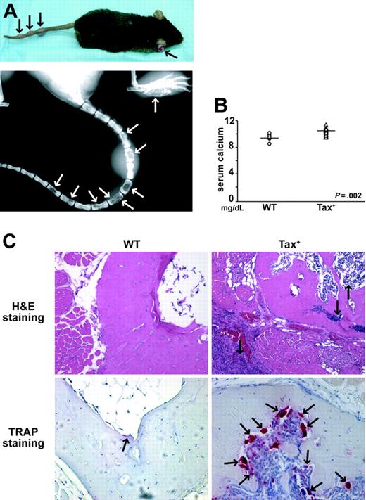 Figure 1. Tax+ mice develop osteolytic bone lesions and hypercalcemia of malignancy. (A) Between the ages of 4 and 12 months, Tax+ mice develop large granular leukemia/lymphoma tumors on the tails, legs, and ears (black arrows). Radiographic imaging demonstrates osteolytic bone destruction (white arrows) in the tail vertebra and the feet of a Tax+ mouse. (B) Dot plot of serum calcium (Ca2+) levels of tumor-bearing Tax+ mice (n = 19) and wild-type age-matched controls (n = 8). Tax+ mice had significantly higher serum Ca2+ (P < .01). (C) Tartrate-resistant acid phosphatase (TRAP) staining on decalcified tail vertebra of a representative Tax+ mouse. Hematoxylin-eosin staining shows tumor cells in the bone marrow, cortical bone, and subcutaneous tissue of a Tax+ mouse as indicated by arrows (top, × 20). TRAP stain of decalcified tail vertebra shows increased osteoclast recruitment at the marrow bone interface (bottom, × 20).