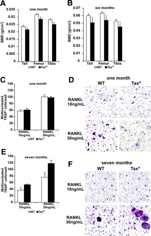 Figure 2. Tumor-bearing Tax mice have decreased bone mineral density and enhanced osteoclastogenesis. (A-B) Bone mineral density (BMD) of Tax+ mice measured by dual-energy x-ray absorptiometry (DEXA) is depicted as the mean ± SEM. One-month-old Tax+ mice have normal BMD on tails, tibias, and femurs as compared with their wild-type littermates (P > .05, n = 10). Tumor-bearing Tax+ mice have significantly decreased BMD on tails, tibias, and femurs as compared with the wild-type littermates (*P < .05, n = 10). (C) Whole bone marrow cells from a 1-month-old Tax+ mouse and a wild-type littermate were cultured in low-dose M-CSF (12 ng/mL) and GST-RANKL (10 ng/mL and 30 ng/mL) for 5 days; cells were fixed and TRAP stained. Three independent experiments were repeated. Multinucleated TRAP-positive osteoclasts of Tax+ mice and wild-type mice were counted and depicted as the mean ± SEM. There was not a significant difference (P > .05), indicating similar osteoclast formation between 1-month-old Tax+ and wild-type mice. (D) Representative TRAP staining of 1-month-old wild-type and Tax+ whole bone marrow–derived osteoclast cultures at day 5 (× 20). (E) Whole bone marrow cells from a 7-month-old Tax+ tumor-bearing mouse and a wild-type littermate cultured under low M-CSF (12 ng/mL) and GST-RANKL (10 ng/mL and 30 ng/mL) for 5 days; cells were fixed and TRAP stained. Three independent experiments were repeated. Multinucleated TRAP-positive osteoclasts of Tax+ mice were more abundant compared with wild-type mice, indicating enhanced osteoclast formation in tumor-bearing Tax+ mice (*P < .01). (F) Representative TRAP staining of 7-month-old wild-type and Tax+ whole bone marrow osteoclast cultures at day 5 (× 20).