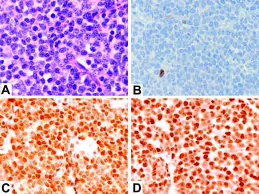 Figure 2. Cytologic features and expression of D-type cyclins in cyclin D1-negative MCL. (A) Typical MCL cytology (case 1) (hematoxylin and eosin stain; original magnification, × 500); (B) cyclin D1 protein, showing only a rare nontumor cell with nuclear staining (case 1); (C) cyclin D2 protein, showing strong nuclear staining of the tumor cells (case 2); (D) cyclin D3 protein, showing strong nuclear staining of the tumor cells (case 4). Panels B-D are immunoperoxidase stains; original magnification, × 400. Figure S1 provides high-power photos of cytomorphology of other 5 cases.