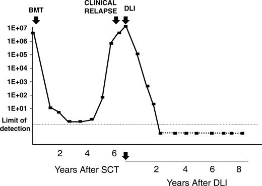 Figure 4. Assessment of disease burden after TCD allogeneic SCT and after DLI in a patient with CLL. Real-time quantitative PCR analysis of the CLL-specific IgH rearrangement was performed on BM samples obtained serially from this patient at the times shown following allogeneic SCT and following DLI.