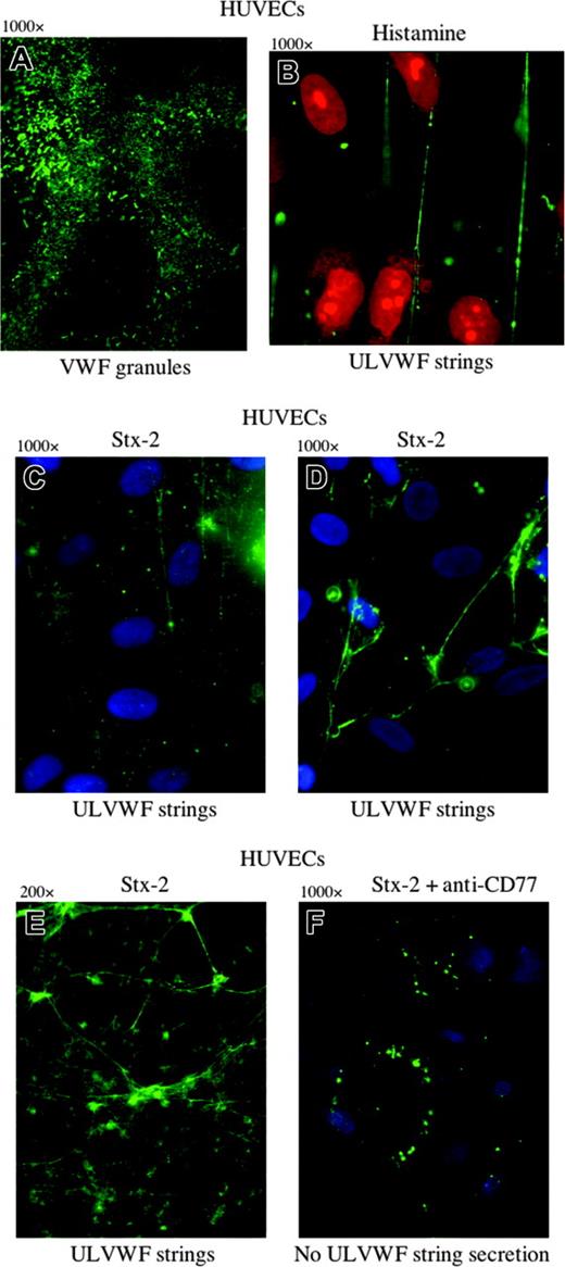 Figure 2. ULVWF strings are secreted from HUVECs stimulated by histamine or by the binding of Stx-2 to Gb3. Green VWF granules (A,F) or strings (B-E) were visualized by fluorescence microscopy using rabbit anti-human VWF IgG and goat anti-rabbit IgG-FITC or IgG-Alexa Fluor 488. (A) Unstimulated HUVECs permeabilized by Triton-X and fixed with paraformaldehyde contain cytoplasmic VWF-containing granules. (B) HUVECs stimulated under flowing conditions with the known VWF secretagogue, histamine (0.1 mM), secrete long ULVWF strings. HUVEC nuclei were stained by propidium iodide (red). In panels A and B, the cells were fixed with 1% paraformaldehyde in PBS and made permeable with Triton-X (in panel B after cell stimulation). The cells were unfixed in panels C-F. HUVECs stimulated by Stx-2 (1 nM) secrete ULVWF strings (C), which often become entangled (D-E). HUVEC nuclei in panels C, D, and are stained blue with DAPI. Original magnification × 1000 for all panels, except panel E, which is × 200. (F) Preincubation of HUVECs with monoclonal mouse anti-human Gb3 (CD77; 5 ng/mL) blocks Stx-2 stimulated ULVWF multimeric string secretion under flowing conditions. Only intracellular VWF granules in clumps near the cell surface are demonstrated in the unfixed cells with the VWF stimulation blocked. HUVECs in all experiments were either in primary culture or passage 1. Each of these photos is representative of 3 to 20 experiments.