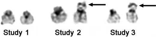 Figure 1. Cytogenetic studies demonstrating donor origin of leukemic cells. Composites of the 22 chromosomes from pretransplantation (study no. 1), 6 months after transplantation, when molecular studies demonstrated 100% donor chimerism (study no. 2), and following diagnosis of AML (study no. 3), illustrating informative G-band polymorphism. One donor chromosome 22 has an enlarged short arm and satellite region, designated by the arrow. This polymorphism is seen in studies 2 and 3, suggesting donor origin of the leukemic cells. G-band polymorphisms represent regions that differ between individuals but have no clinical significance. They are most commonly seen on acrocentric chromosomes such as chromosome 22.
