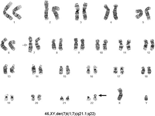 Figure 2. Cytogenetic studies demonstrating clonal abnormality. Studies performed after transplantation at diagnosis of AML revealed a clone characterized by a derivative chromosome 7 (marked by arrow). The chromosome 22 polymorphisms are consistent with donor origin of these cells (marked by bold arrow).