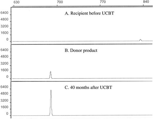 Figure 3. Assessment of donor chimerism. Electrophoretic profiles of informative VNTR PCR products of the recipient before transplantation (allele size 836 bp) (A), the donor product before transplantation (allele size 690 bp) (B), and the recipient following the diagnosis of leukemia demonstrating 100% donor cells (C). The donor and recipient were both homozygous for the respective alleles.