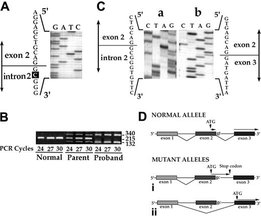 Figure 1. Genetic characterization of band 3 Neapolis mutation. (A) Genomic analysis. Sequence of PCR-amplified genomic DNA of proband band 3. The sequence shown encompasses the donor splice site of intron 2. Note that the second nucleotide of intron 2 was changed from T to C. (B) RT-PCR analysis. Reticulocyte cDNAs were PCR amplified using primers localized in exons 1 and 3. cDNA of a healthy subject generated a 215-bp band. Two bands of 340 bp and 132 bp were noted in the cDNA of the proband. In the heterozygous parent (the mother), all 3 amplified products were seen. A similar pattern also was seen using cDNA from the father (data not shown). (C) Sequencing of PCR products. The 2 abnormal amplified products obtained in the proband (panel 1B, 340 bp and 132 bp) were sequenced. The 340-bp fragment corresponds to mRNA in which intron 2 is retained, and the 132-bp fragment corresponds to mRNA in which exon 2 is skipped. (D) Schematic diagram of the different patterns of splicing. In contrast to normal splicing shown in the top panel, 2 aberrant splicing patterns are seen in band 3 Neapolis. Retaining of intron 2 leads to a premature termination of translation after the 19th triplet (i), and skipping of exon 2 leads to a loss of the normal translation start site for erythroid AE1 protein (ii).