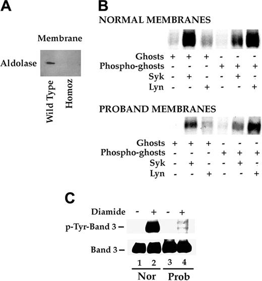 Figure 4. Band 3 Neapolis functions: binding of glycolytic enzymes and protein phosphorylation. (A) Aldolase binding to normal and mutant band 3. Red-cell membrane proteins from a healthy subject and the proband were separated by SDS-PAGE, transferred to a nitrocellulose paper, and analyzed by immunoblotting using an anti-aldolase antibody. (B) Sequential phosphorylation of band 3 in vitro. Red-cell membrane proteins were subjected to various treatments as outlined. Specifically, ghosts were incubated with Syk (lane 2) or with Lyn (lane 3) or without the enzymes (lane 1). Phosphate incorporation was evaluated on the basis of 32P signal (determined by exposing dried gels to x-ray films). In lanes 4, 5, and 6, membranes that were previously treated with Syk in the presence of unlabeled phosphate were incubated with Syk (lane 5) or with Lyn (lane 6) in the presence of labeled phosphate. Lane 4 is a control without addition of either Syk or Lyn. (C) Phosphorylation of band 3 in vivo. Red blood cells were incubated in the absence or presence of diamide. Cell membranes were isolated, solubilized, and submitted to SDS-PAGE followed by transfer to nitrocellulose. The upper part of blot shows immunostaining of band 3 with antiphosphotyrosine antibody. The filter was stripped and reprobed with anti-band 3 antibody (bottom panel). Nor indicates control membranes; Prob, proband membranes.