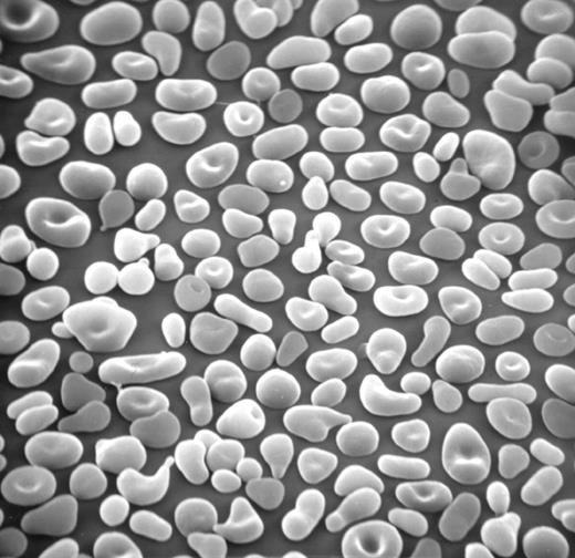 Scanning electron micrograph documenting morphology of red cells in the kindred from the original HPP family. Marked red cell shape abnormalities include cells with blunted or triangular projections, as well as microspherocytes.